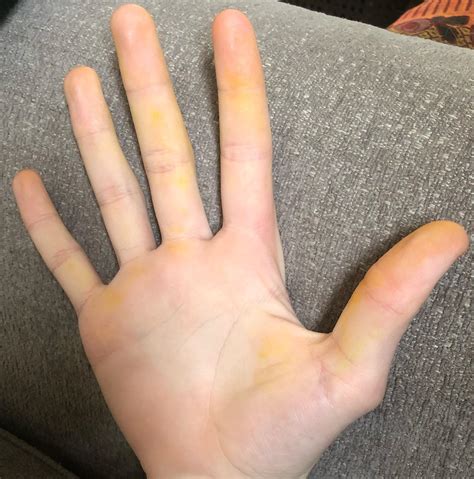 Yellow Spots On Palm Of One Hand at Gabriel Williamson blog