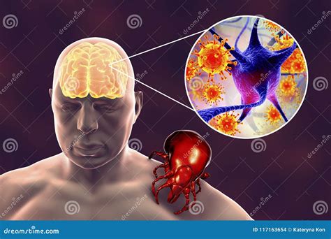 Tick-borne Encephalitis Concept Stock Illustration - Illustration of ...