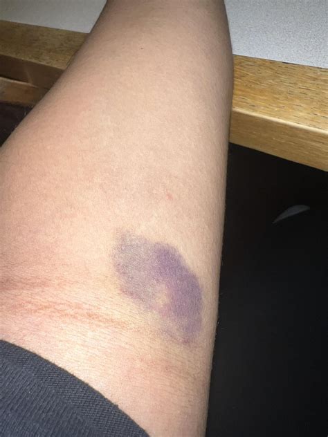 Bruise after Blood Draw - This small vein had never been touched before. 4 days out. Should I be ...