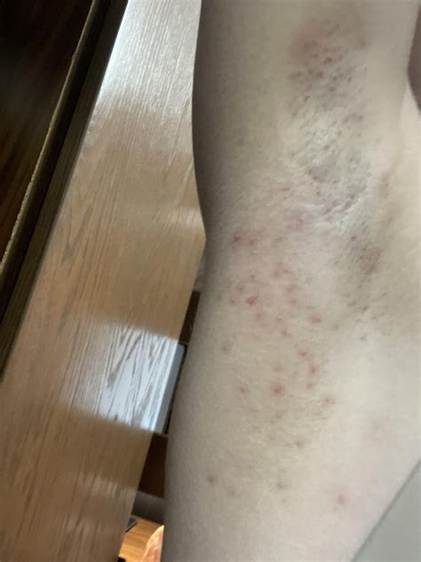 underarm rash (18F) text in comments : r/DermatologyQuestions