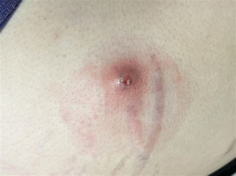 Ingrown Hair Infection Stomach How To Prevent And Treat Ingrown Pubic