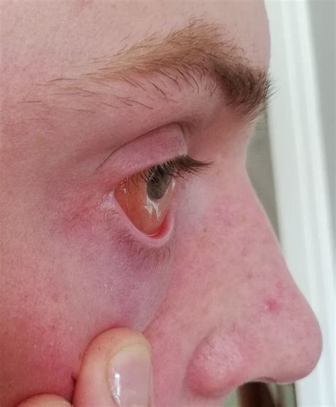 Swollen Eyeball Allergic Reaction
