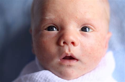 Baby Allergy Rash On Face