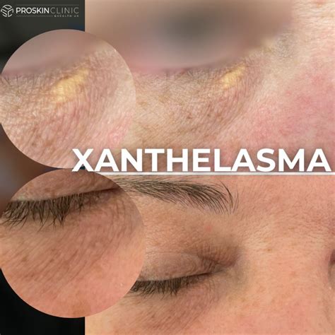 Xantelasma Xanthelasma Removal London Dermasurge Clinic