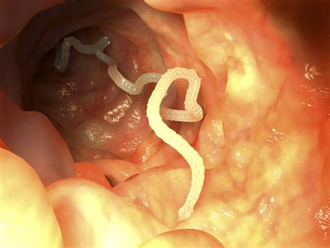 Tapeworm: Symptoms, Causes, Diagnosis, Treatment