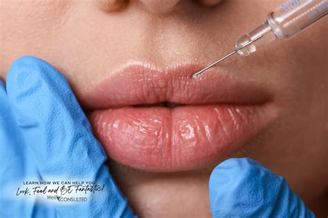 Botox Lip Flip Before and After - WellConsulted