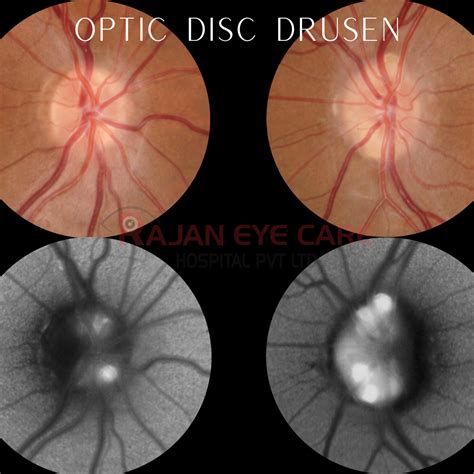 Optic Disc Drusen — Ophthalmobytes