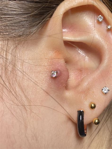 Ear Piercing Keloid Vs Infection at Lucas Oshanassy blog