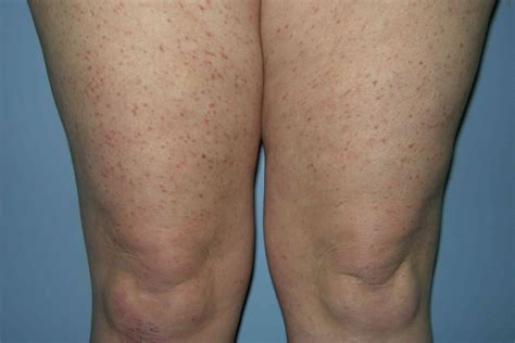 Urticaria Pigmentosa: Lesions, Mastocytosis, Treatment