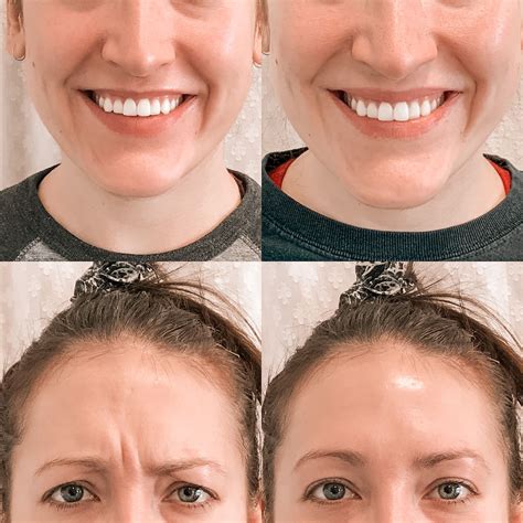Botox Lips Before And After Photos at Inez Smith blog