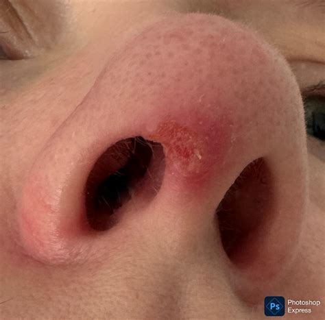 Nasal Ulcers Lupus Lupus Overview For Journalist