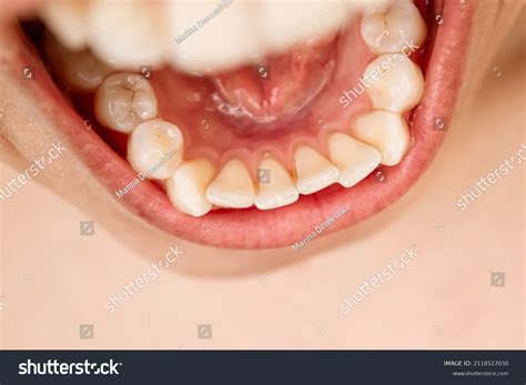 25,383 Inside Tooth Images, Stock Photos & Vectors | Shutterstock