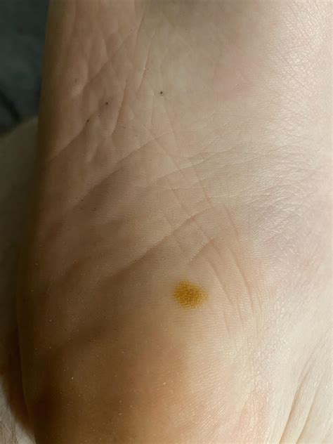 Sole Yellowing at Gary Delariva blog