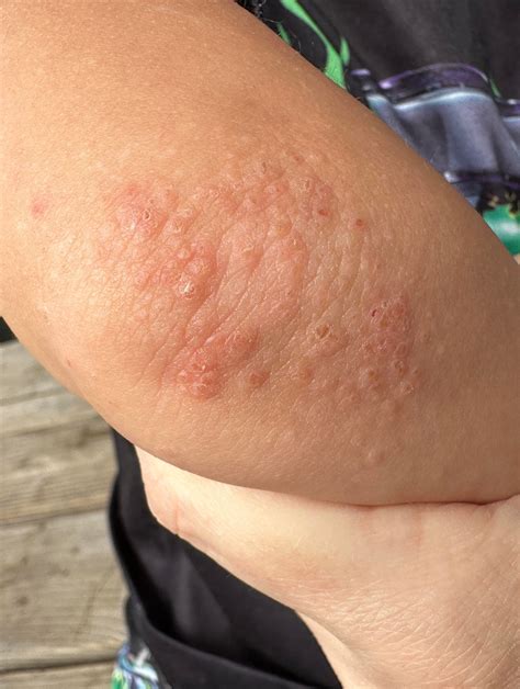 3 year old bilateral elbow rash : r/DermatologyQuestions