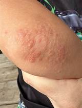 3 year old bilateral elbow rash : r/DermatologyQuestions