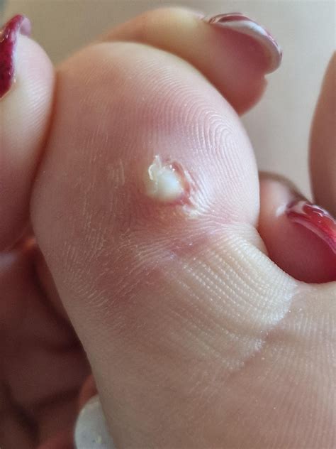 Just popped a cyst sac out the bottom of my toe : r/popping