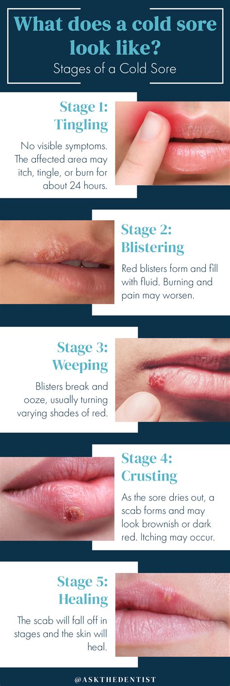 What Causes Multiple Cold Sore Outbreaks at Caitlyn Philp blog
