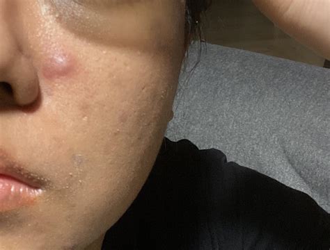 Not sure what this bump is? It starts hard, when squeezed it has no ...