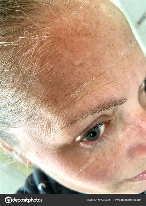 Visage D'une Femme Avec Mélasme Hyper Pigmentation Maladie D'addison Rare image libre de droit ...