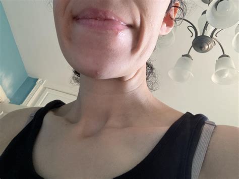 Is this a keloid scar on my lower lip? : r/Keloids