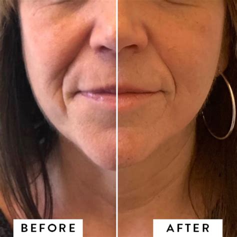 Radio Frequency Face Lift Montreal | Reimagine Clinic