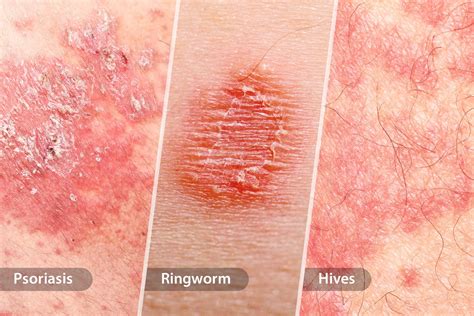 Severe Eczema Rash On Face