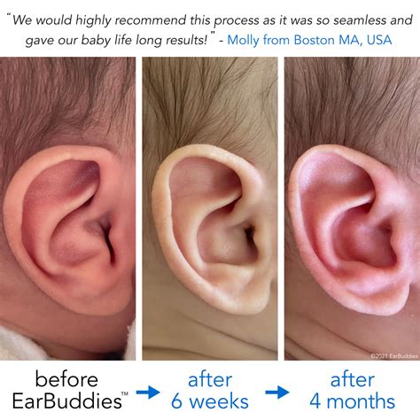 Babys Ears starting to Stick Out or Fold Over? | EarBuddies™
