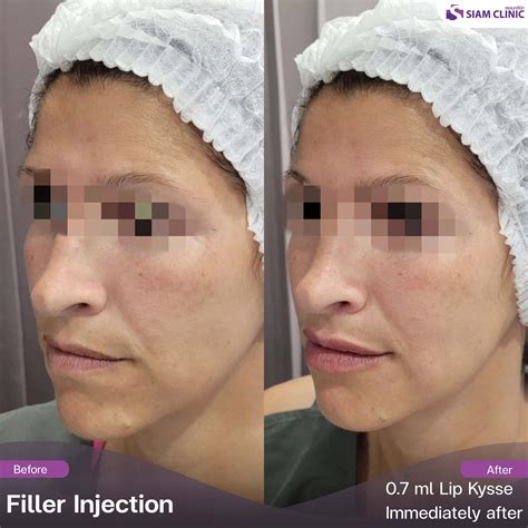 Lip Fillers Before and After Photos - Siam Clinic Thailand