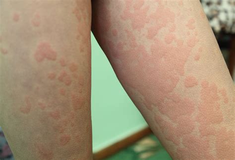 Rash With Hives