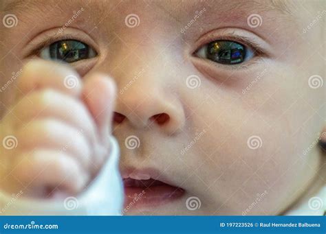 A Baby With Eyes Full Of Rheum, Produced By Conjunctivitis, Inflammation Of The Conjunctiva Of ...