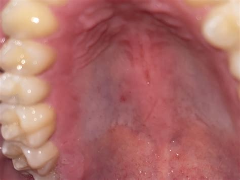 Can anyone tell me if these white spots on the roof of my mouth look ...