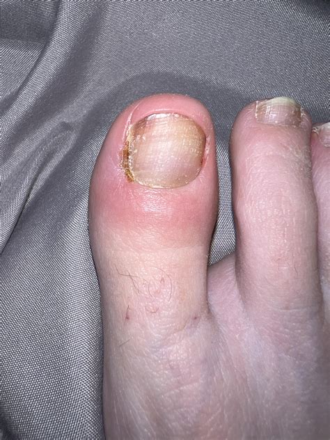 Retronychia after partial nail avulsion : r/Ingrown_Toenails