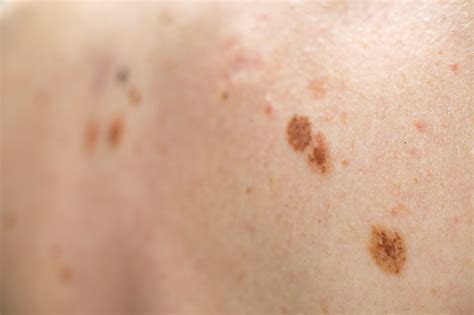 Atypical Moles - SJH Derm