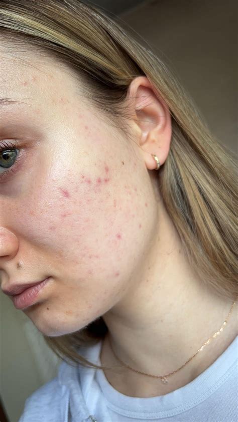 [Acne] Adapalene Purge : r/SkincareAddiction