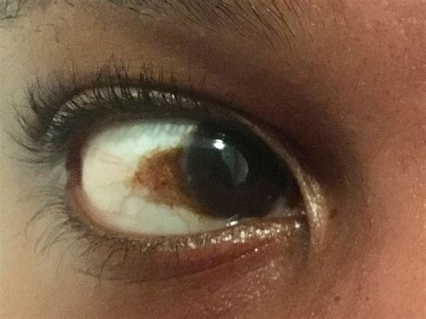 What Are These Black Spots In My Eyes at Piper Walton blog