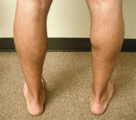 Gastrocnemius Rupture