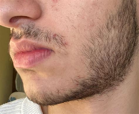 I have been growing my facial hair for 2 weeks now, but my mustache doesn’t connect to the rest ...