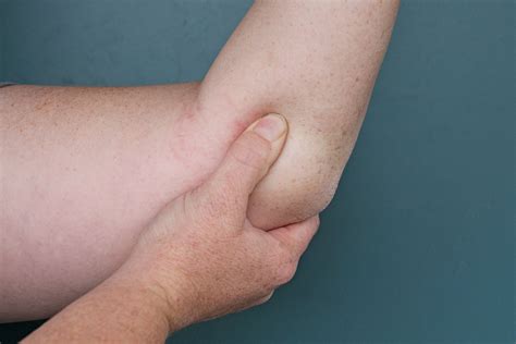 How to Wrap and Tape a Tennis Elbow | Livestrong.com | Tennis elbow ...