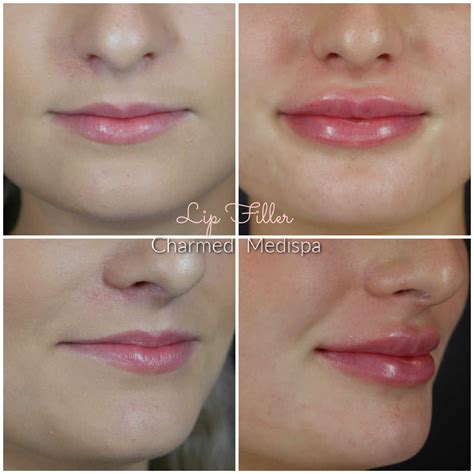 Lip Filler – A Variety Of Techniques – Charmed Medispa
