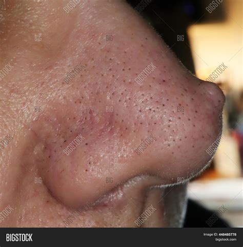 Nostril Warts Inside
