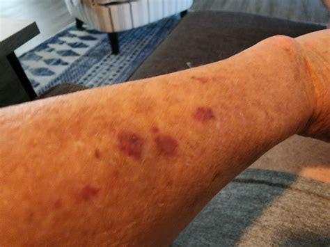 Bruising easily : r/medical