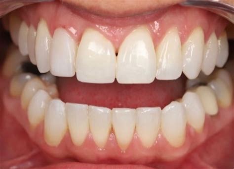 Gum Abscess Popped? Thinking of Popping It Yourself?