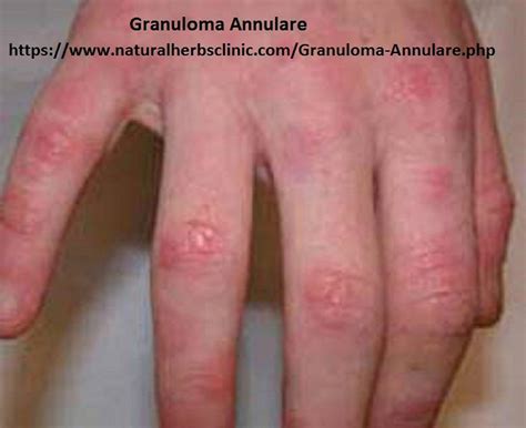 Granulooman Annulare - Ilmainen valokuva Pixabayssa - Pixabay