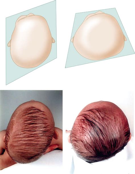 Plagiocephaly - Clinical Tree