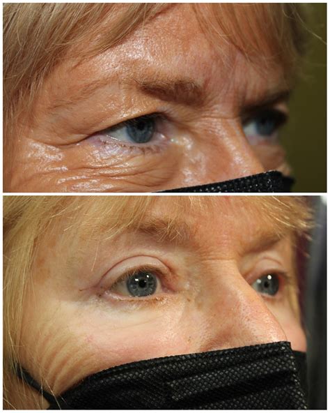Eyelid Surgery | Pacific Eye Surgeons