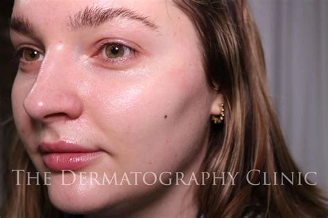 Beauty Dot Tattoos Woman Divides Opinion By Having A Beauty Spot