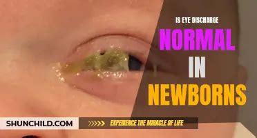 Newborn Dry Skin: What's Normal And What's Not? | ShunChild