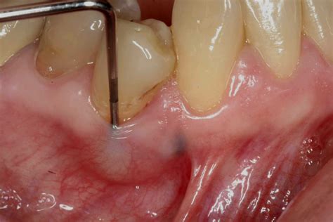 Visual Guide to Tooth Abscess Stages: Pictures, Symptoms, and Treatment - Chaztin