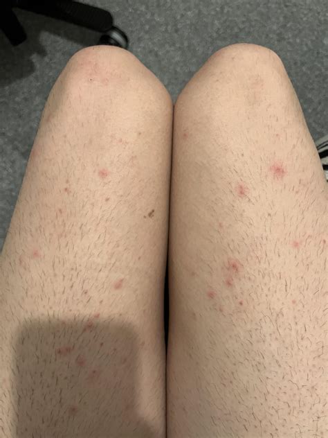 acne on legs : r/acne