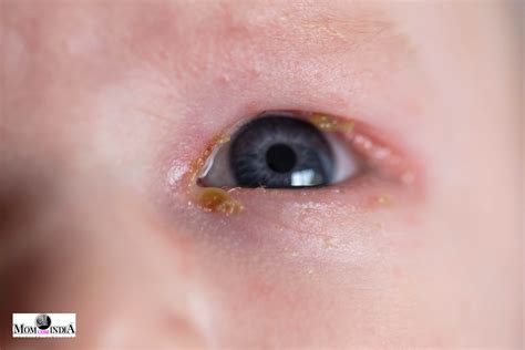Newborn Eye Sticky